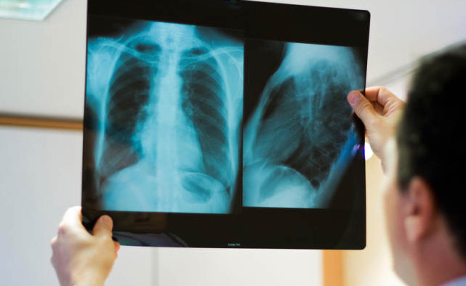 osteosarcoma sintomas tratamiento