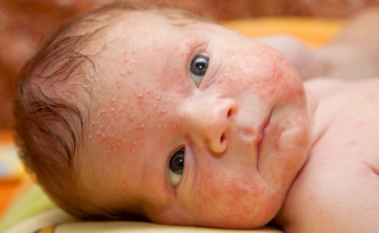 clinica internacional bebe sarpullido cara razones