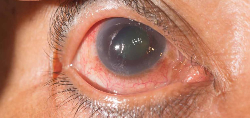 que es glaucoma clinica internacional